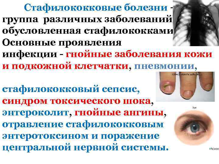 Стафилококковые болезни – группа различных заболеваний, обусловленная стафилококками. Основные проявления инфекции - гнойные заболевания