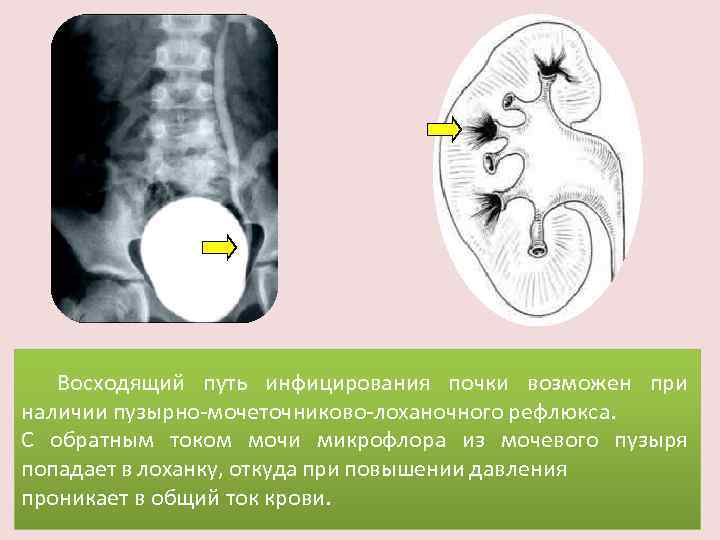 Восходящий путь инфицирования почки возможен при наличии пузырно-мочеточниково-лоханочного рефлюкса. С обратным током мочи микрофлора