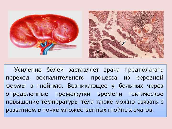 Усиление болей заставляет врача предполагать переход воспалительного процесса из серозной формы в гнойную. Возникающее