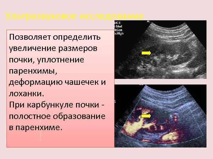 Уплотнение члс обеих почек