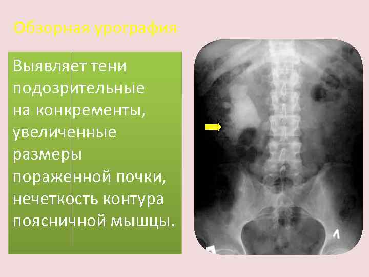 Обзорная урография Выявляет тени подозрительные на конкременты, увеличенные размеры пораженной почки, нечеткость контура поясничной