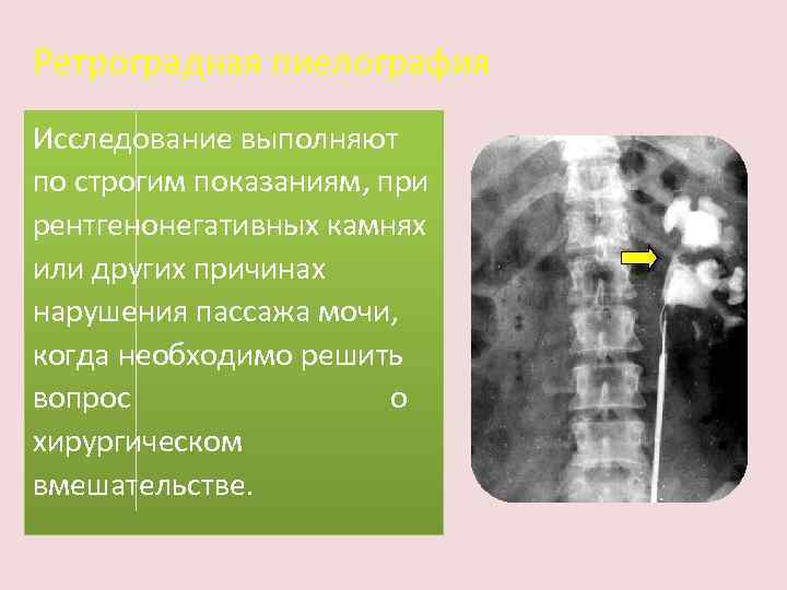 Ретроградная пиелография Исследование выполняют по строгим показаниям, при рентгенонегативных камнях или других причинах нарушения