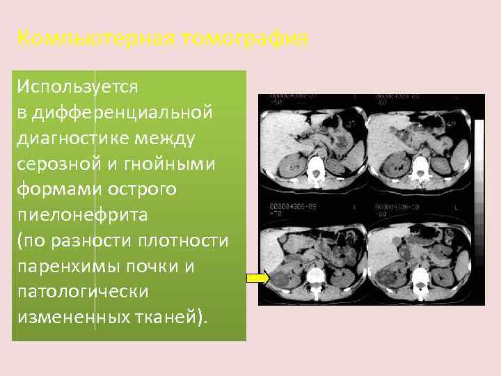 Компьютерная томография Используется в дифференциальной диагностике между серозной и гнойными формами острого пиелонефрита (по