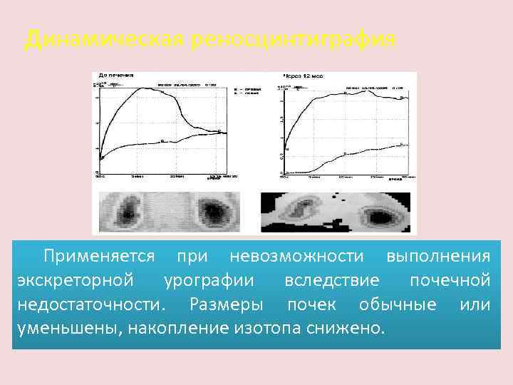 Динамическая реносцинтиграфия Применяется при невозможности выполнения экскреторной урографии вследствие почечной недостаточности. Размеры почек обычные