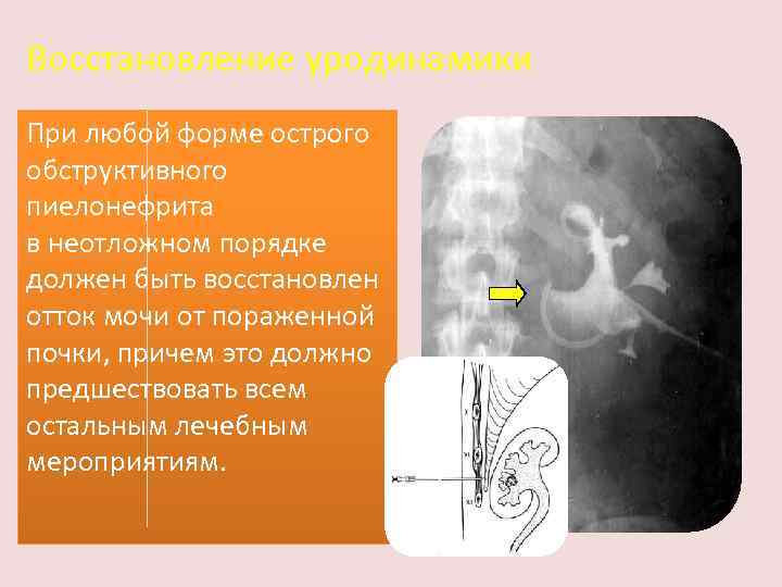 Восстановление уродинамики При любой форме острого обструктивного пиелонефрита в неотложном порядке должен быть восстановлен