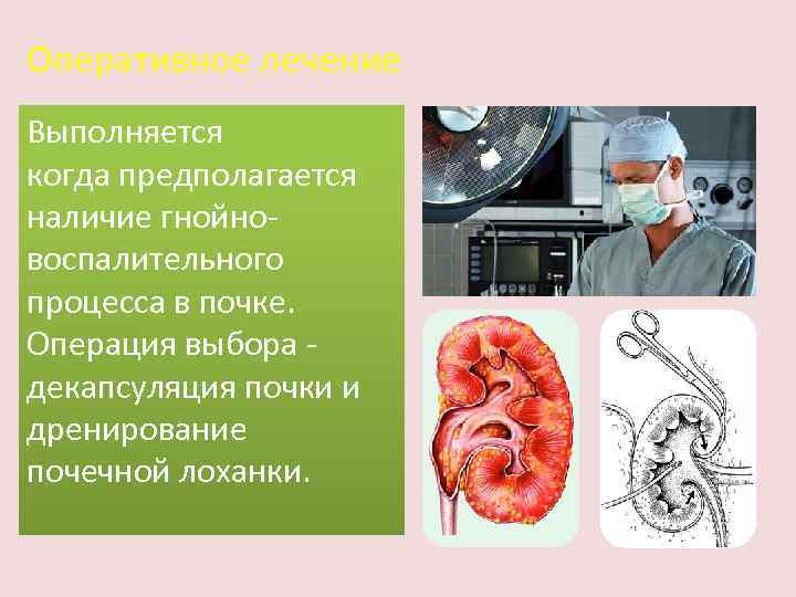 Оперативное лечение Выполняется когда предполагается наличие гнойновоспалительного процесса в почке. Операция выбора декапсуляция почки