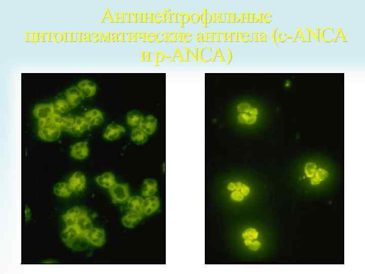 Антинейтрофильные цитоплазматические антитела (c-ANCA и p-ANCA) 