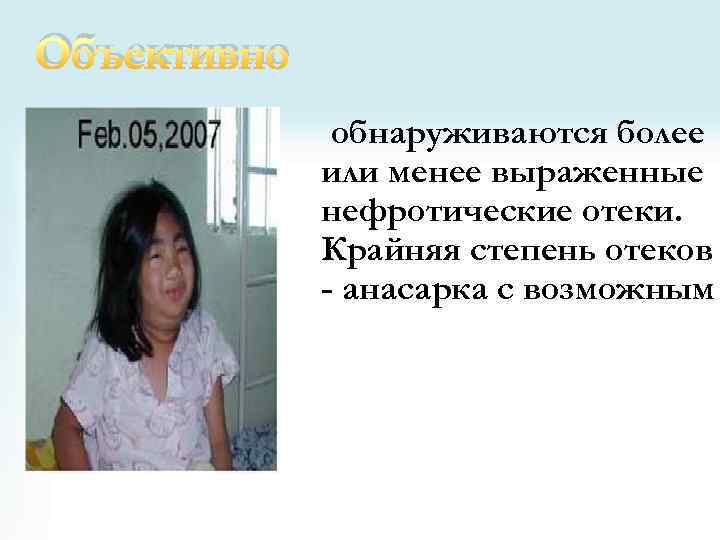 Объективно обнаруживаются более или менее выраженные нефротические отеки. Крайняя степень отеков - анасарка с