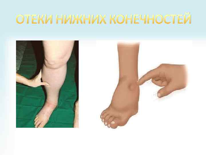 ОТЕКИ НИЖНИХ КОНЕЧНОСТЕЙ 