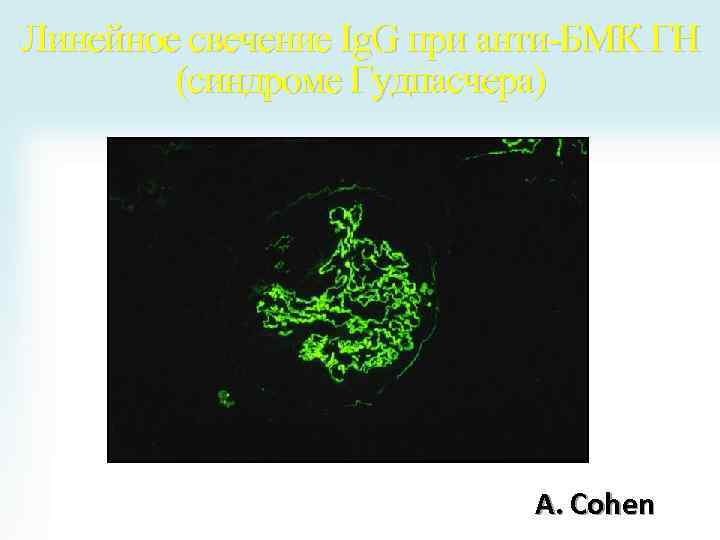 Линейное свечение Ig. G при анти-БМК ГН (синдроме Гудпасчера) A. Cohen 
