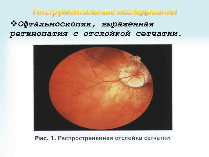 Инструментальные исследования v. Офтальмоскопия, выраженная ретинопатия с отслойкой сетчатки. 