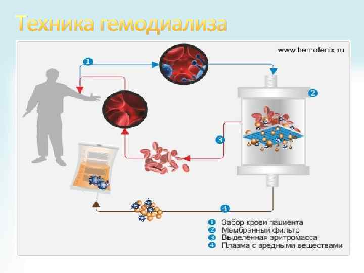 Техника гемодиализа 