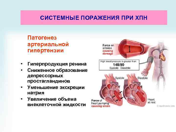 СИСТЕМНЫЕ ПОРАЖЕНИЯ ПРИ ХПН Патогенез артериальной гипертензии • Гиперпродукция ренина • Сниженное образование депрессорных