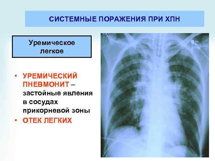 СИСТЕМНЫЕ ПОРАЖЕНИЯ ПРИ ХПН Уремическое легкое • УРЕМИЧЕСКИЙ ПНЕВМОНИТ – застойные явления в сосудах