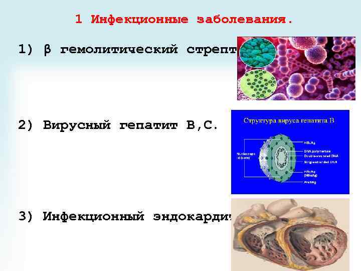 1 Инфекционные заболевания. 1) β гемолитический стрептококк. 2) Вирусный гепатит В, С. 3) Инфекционный