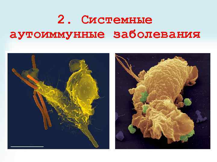 2. Системные аутоиммунные заболевания 