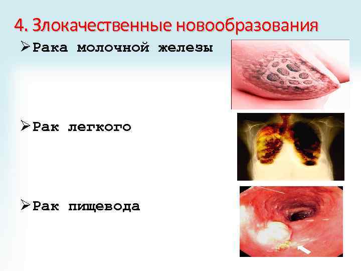 4. Злокачественные новообразования ØРака молочной железы ØРак легкого ØРак пищевода 