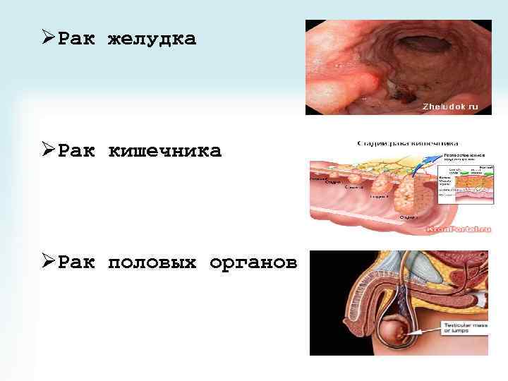 ØРак желудка ØРак кишечника ØРак половых органов 