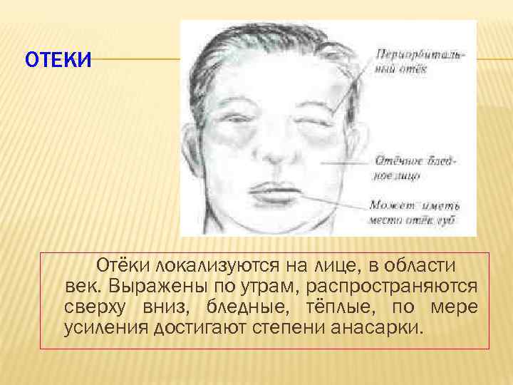 ОТЕКИ Отёки локализуются на лице, в области век. Выражены по утрам, распространяются сверху вниз,