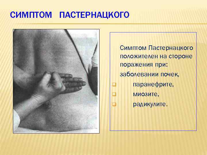 СИМПТОМ ПАСТЕРНАЦКОГО q q q Симптом Пастернацкого положителен на стороне поражения при: заболевании почек,