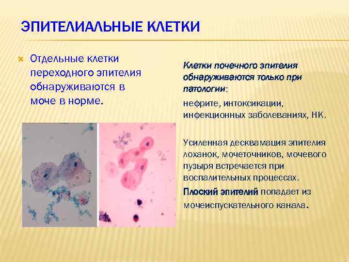 ЭПИТЕЛИАЛЬНЫЕ КЛЕТКИ Отдельные клетки переходного эпителия обнаруживаются в моче в норме. Клетки почечного эпителия