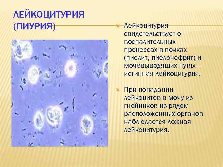 ЛЕЙКОЦИТУРИЯ (ПИУРИЯ) Лейкоцитурия свидетельствует о воспалительных процессах в почках (пиелит, пиелонефрит) и мочевыводящих путях