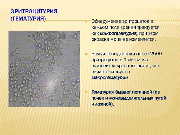 ЭРИТРОЦИТУРИЯ (ГЕМАТУРИЯ) Обнаружение эритроцитов в каждом поле зрения трактуется как микрогематурия, при этом окраска