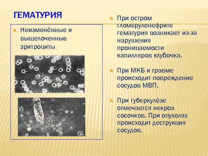 ГЕМАТУРИЯ При остром гломерулонефрите гематурия возникает из-за нарушения проницаемости капилляров клубочка. При МКБ и