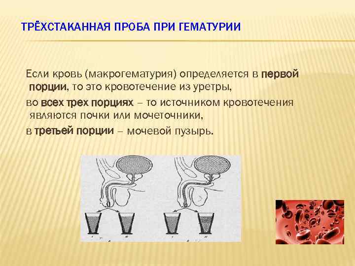 ТРЁХСТАКАННАЯ ПРОБА ПРИ ГЕМАТУРИИ Если кровь (макрогематурия) определяется в первой порции, то это кровотечение