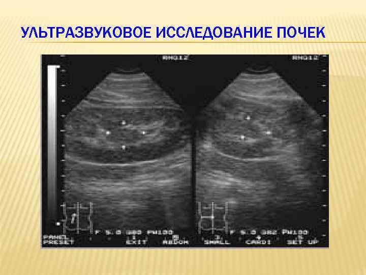 УЛЬТРАЗВУКОВОЕ ИССЛЕДОВАНИЕ ПОЧЕК 