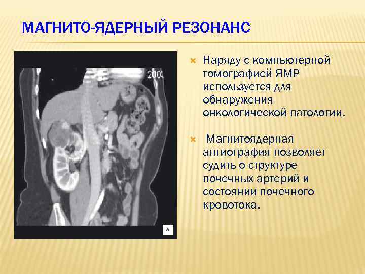 МАГНИТО-ЯДЕРНЫЙ РЕЗОНАНС Наряду с компьютерной томографией ЯМР используется для обнаружения онкологической патологии. Магнитоядерная ангиография