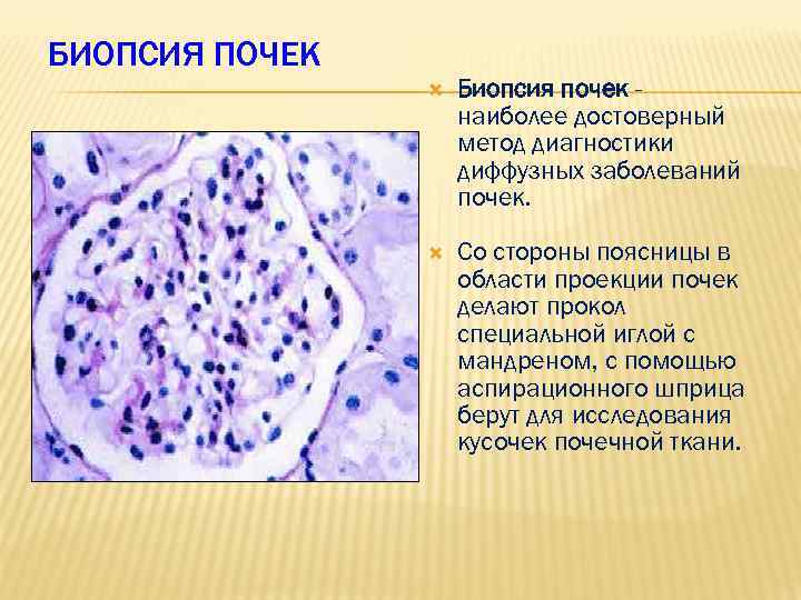 БИОПСИЯ ПОЧЕК Биопсия почек наиболее достоверный метод диагностики диффузных заболеваний почек. Со стороны поясницы