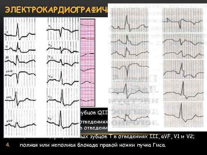 ЭЛЕКТРОКАРДИОГРАФИЧЕСКИЕ ПРИЗНАКИ ТЭЛА 1. внезапное углубление зубцов QIII и SI (признак QIIISI); 2. подъем