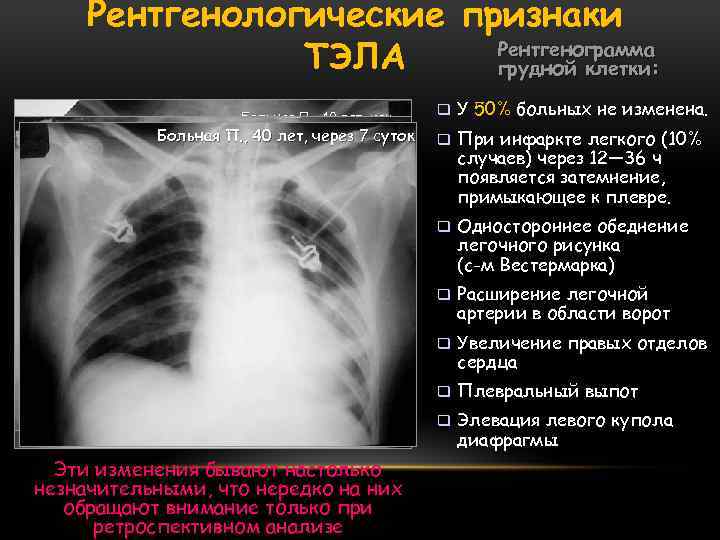 Рентгенологические признаки Рентгенограмма ТЭЛА грудной клетки: Больная П. , 40 лет, исх. Больная П.