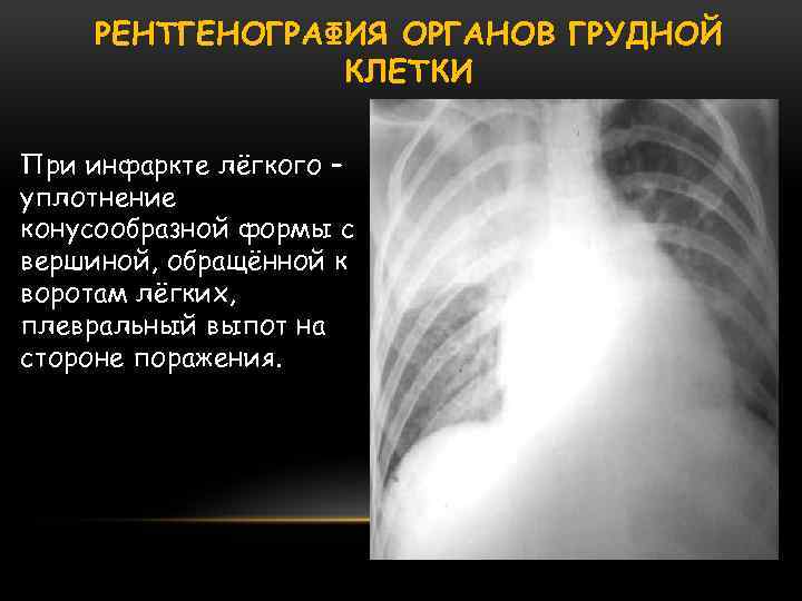 РЕНТГЕНОГРАФИЯ ОРГАНОВ ГРУДНОЙ КЛЕТКИ При инфаркте лёгкого – уплотнение конусообразной формы с вершиной, обращённой