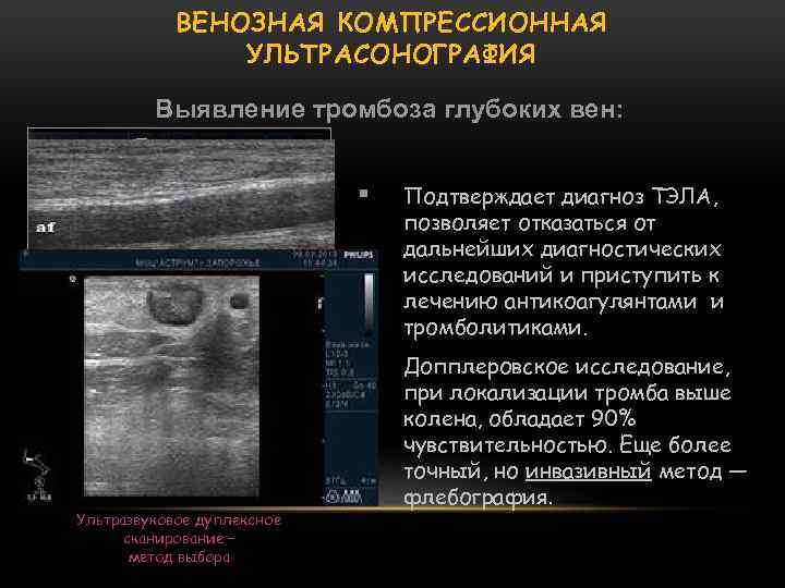 ВЕНОЗНАЯ КОМПРЕССИОННАЯ УЛЬТРАСОНОГРАФИЯ Выявление тромбоза глубоких вен: Ультразвуковое дуплексное сканирование – метод выбора Подтверждает