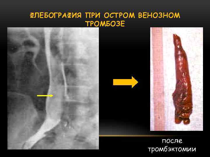 ФЛЕБОГРАФИЯ ПРИ ОСТРОМ ВЕНОЗНОМ ТРОМБОЗЕ после тромбэктомии 