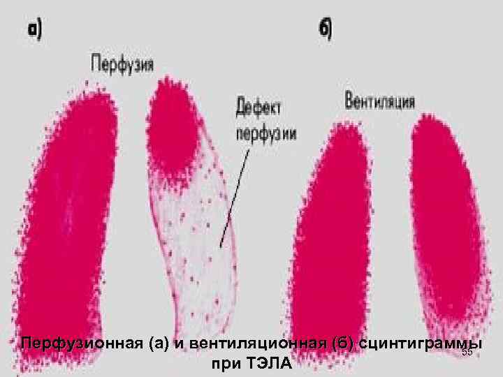 Перфузионная (а) и вентиляционная (б) сцинтиграммы 55 при ТЭЛА 