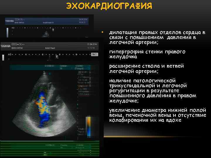 ЭХОКАРДИОГРАФИЯ • дилатация правых отделов сердца в связи с повышением давления в легочной артерии;