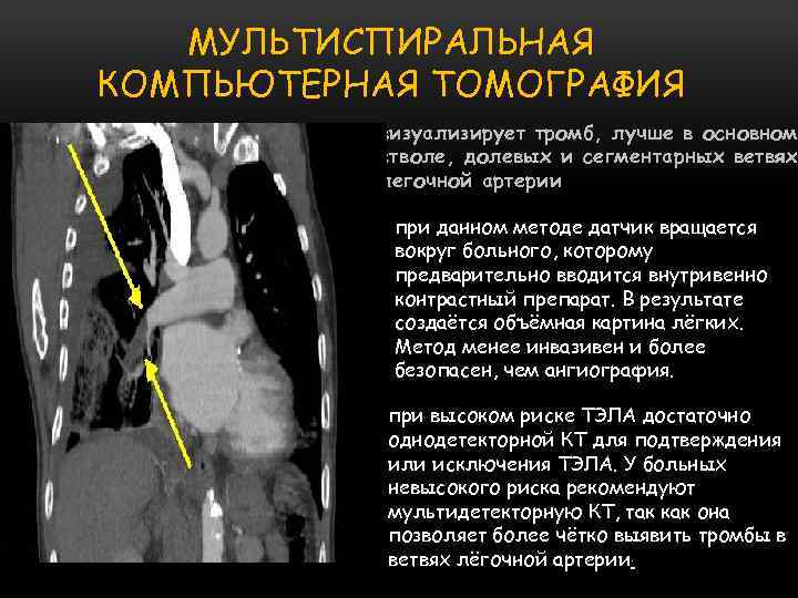 МУЛЬТИСПИРАЛЬНАЯ КОМПЬЮТЕРНАЯ ТОМОГРАФИЯ визуализирует тромб, лучше в основном стволе, долевых и сегментарных ветвях легочной