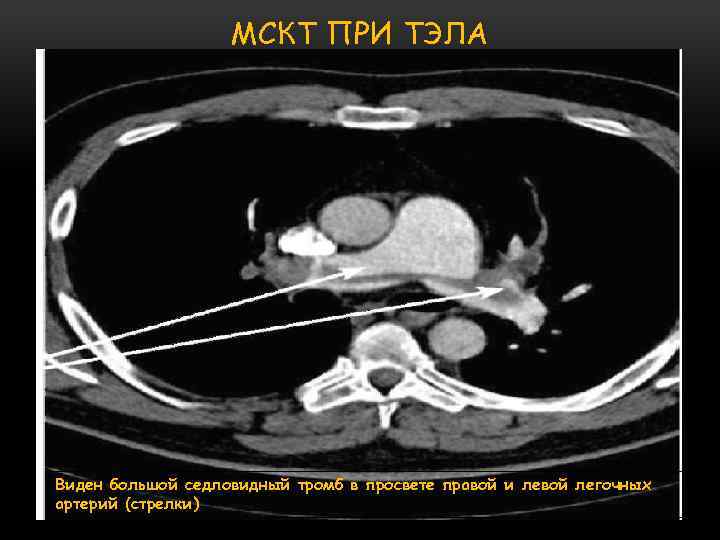 МСКТ ПРИ ТЭЛА Виден большой седловидный тромб в просвете правой и левой легочных артерий