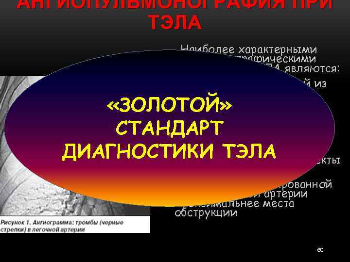 АНГИОПУЛЬМОНОГРАФИЯ ПРИ ТЭЛА 1. Наиболее характерными ангиографическими признаками ТЭЛА являются: полная обтурация одной из