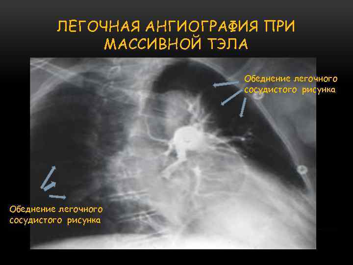 ЛЕГОЧНАЯ АНГИОГРАФИЯ ПРИ МАССИВНОЙ ТЭЛА Обеднение легочного сосудистого рисунка 