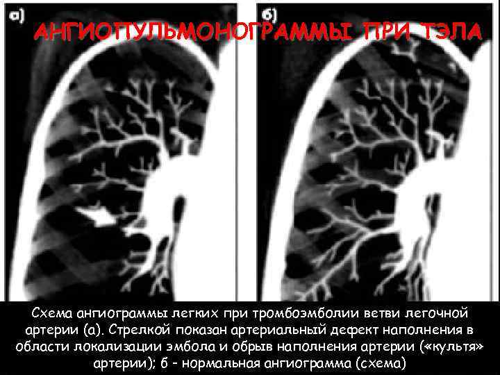 АНГИОПУЛЬМОНОГРАММЫ ПРИ ТЭЛА Схема ангиограммы легких при тромбоэмболии ветви легочной артерии (а). Стрелкой показан