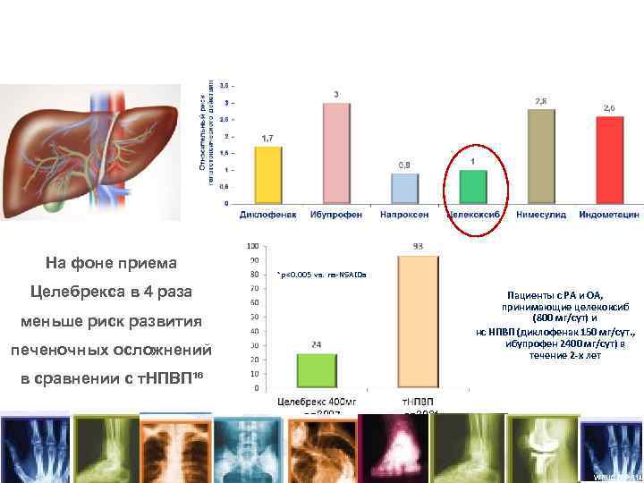 Целебрекс имеет низкий риск развития печеночных осложнений по сравнению с т. НПВП¹⁵ На фоне