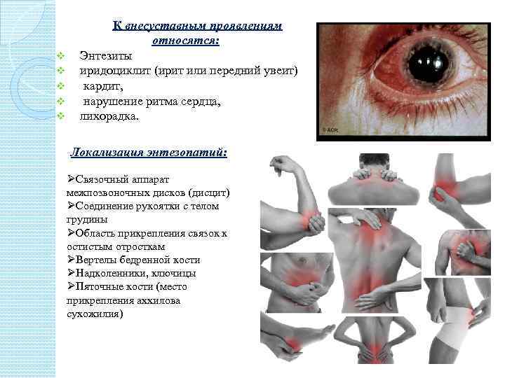 v v v К внесуставным проявлениям относятся: Энтезиты иридоциклит (ирит или передний увеит) кардит,