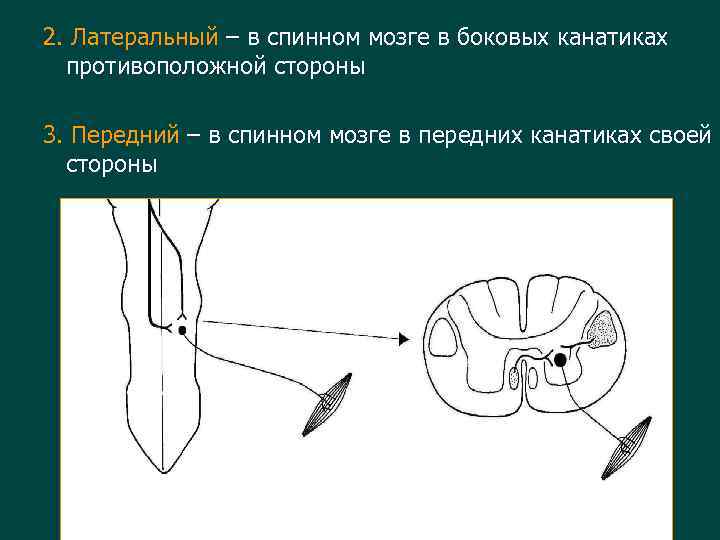 2. Латеральный – в спинном мозге в боковых канатиках противоположной стороны 3. Передний –