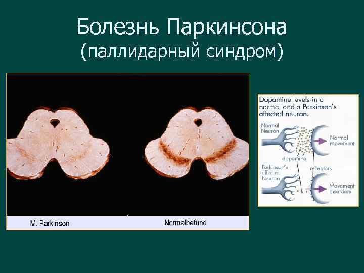 Болезнь Паркинсона (паллидарный синдром) 