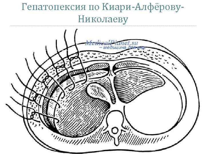 Гепатопексия по Киари-Алфёрову. Николаеву 