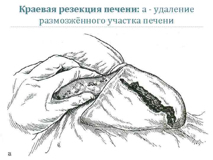 Краевая резекция печени: а - удаление размозжённого участка печени 
